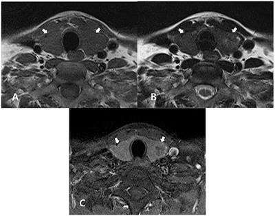 Magnetic Resonance Imaging Features of Normal Thyroid Parenchyma and Incidental Diffuse Thyroid Disease: A Single-Center Study